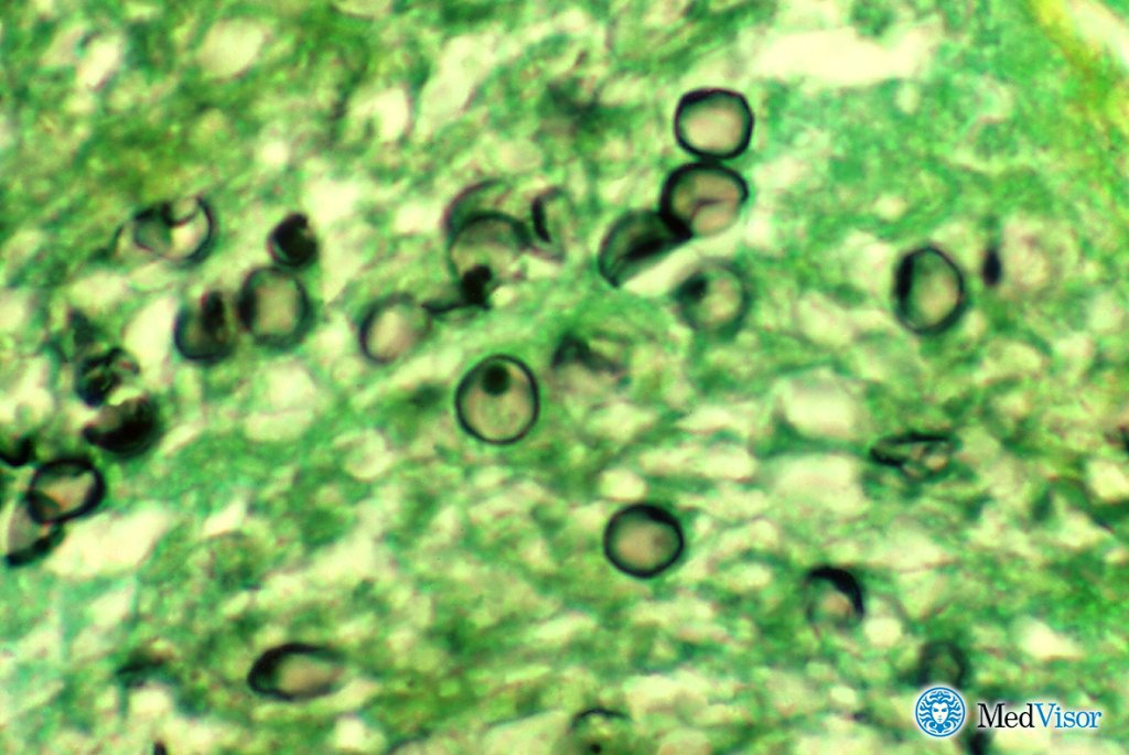 Грибковая пневмония Может ли пневмония протекать без температуры и без кашля
