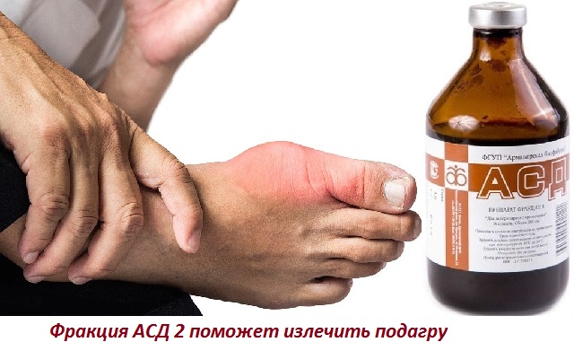 Асд фракция 2 лечение подагры