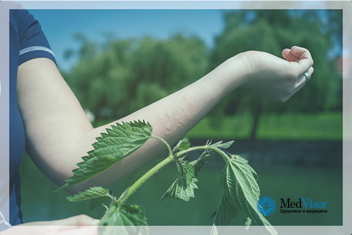 Как выглядит крапивный ожог В чем польза ожога крапивой