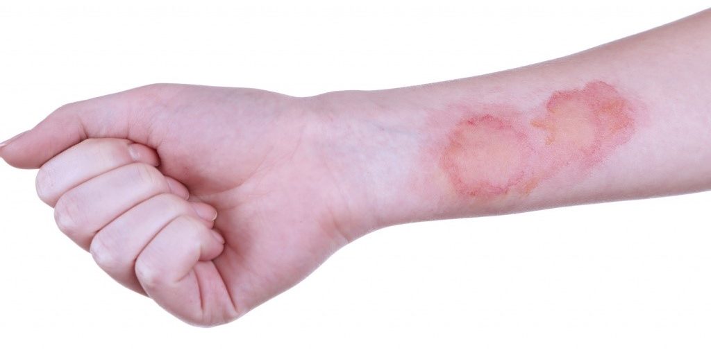 При ожоге нужно много пить