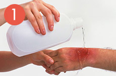 Оказание первой помощи при ожогах при пожаре