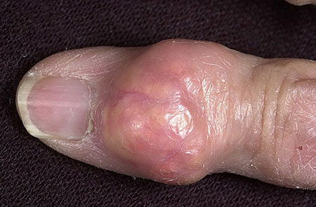 подагрические тофусы на пальце руки