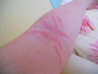 Как убрать ожог от медузы Как убрать ожог от медузы thumbnail