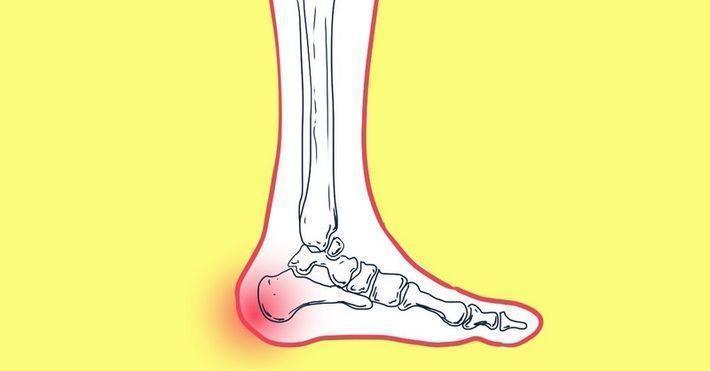 Какие приправы можно при подагре