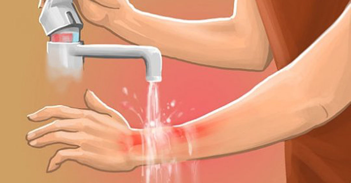 Что будет с кожей при ожоге кратко