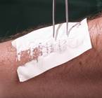 Что будет с кожей при ожоге кратко