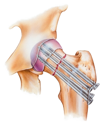 остеосинтез остеосинтез