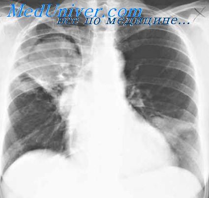 Пневмония кальций хлор при пневмонии Пневмония кальций хлор при пневмонии thumbnail