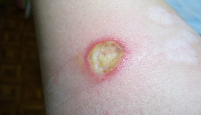 Рана как ожог но не ожог