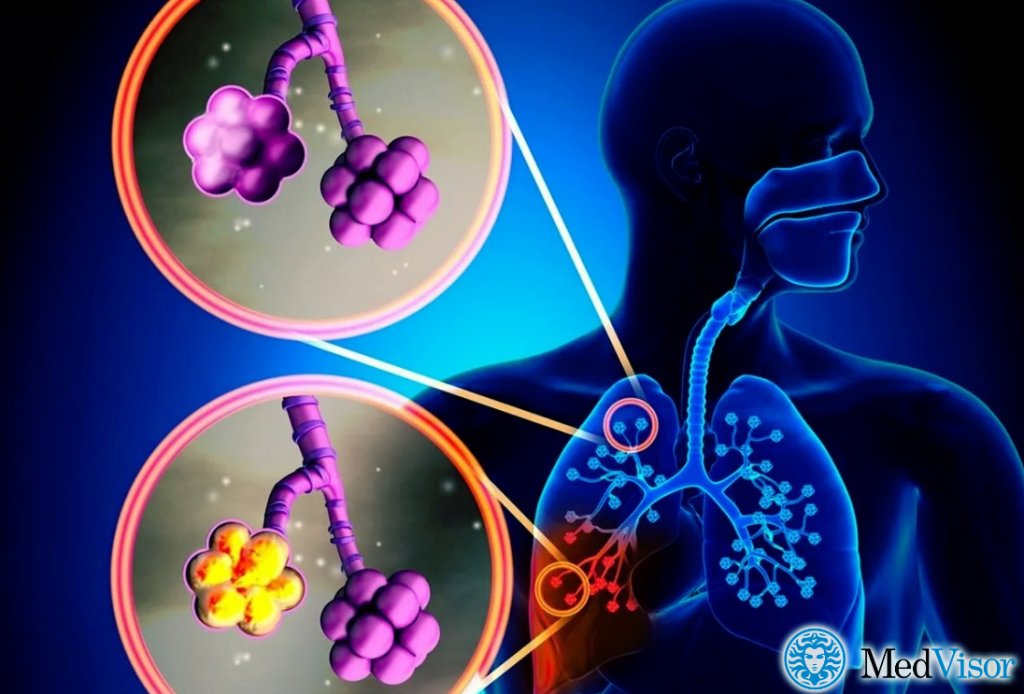 Пневмония без уточнения возбудителя Как понять что бронхит перешел в пневмонию