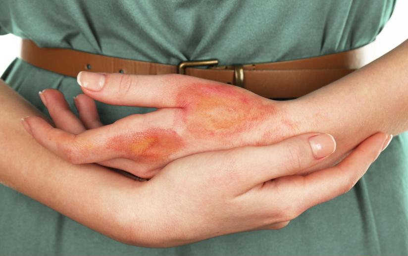 след от ожога