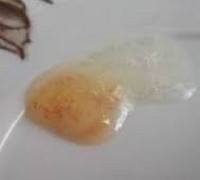 Геморрагическая пневмония Геморрагическая пневмония