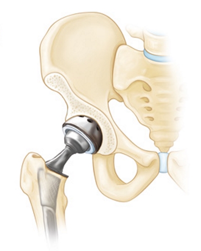 эндопротезирование эндопротезирование