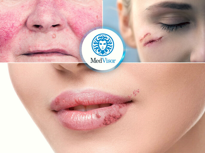 противопоказания для пилинга Ожог салициловой кислотой на лице