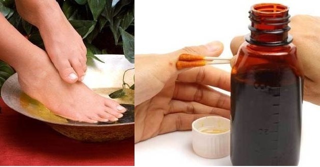 Аспирин с йодом для лечения подагры