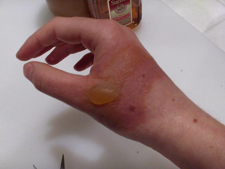 Ожог кипятком когда появляются волдыри