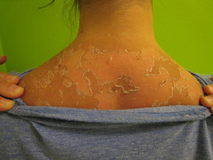 Какая мазь уберет следы от ожога