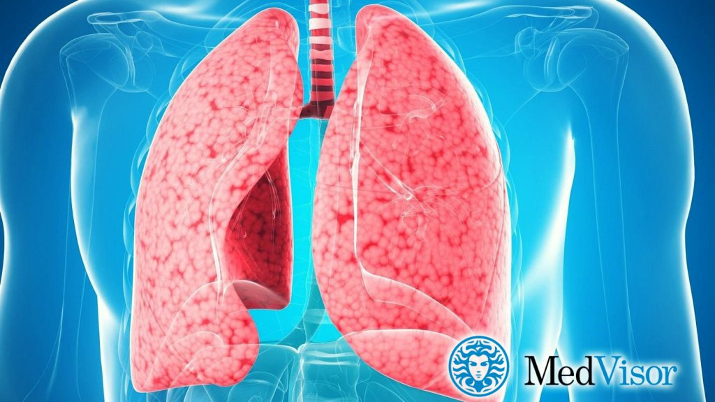 Может ли бронхит перейти в пневмонию? Как понять что бронхит перешел в пневмонию