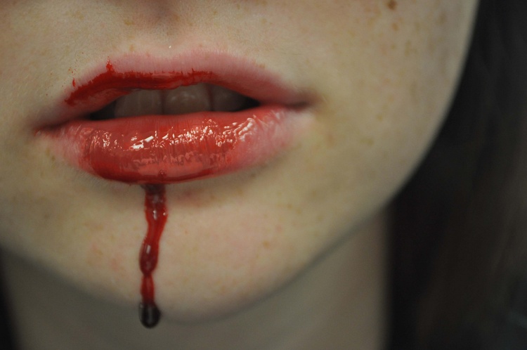 Ожоги губ фото до и после