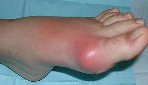 подагра ноги подагра ноги