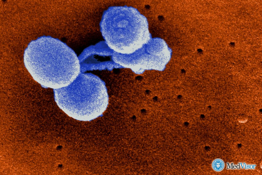 Бактериальная пневмония Может ли пневмония протекать без температуры и без кашля