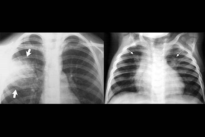 пневмония у стариков прогноз