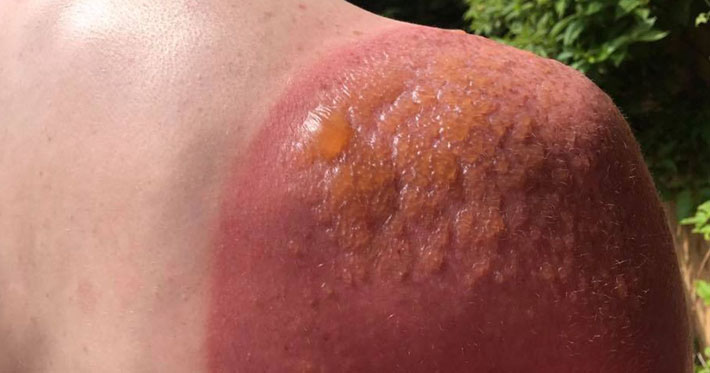 Ожог от солнца