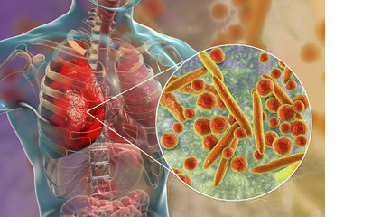 Микоплазменная пневмония симптомы у взрослых Микоплазменная пневмония симптомы у взрослых thumbnail