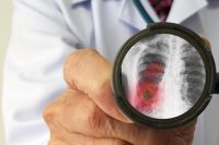 Может ли пневмония протекать без температуры и без кашля