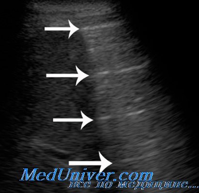 инфильтрация легкого