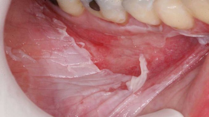 Ожог слизистой оболочки нижней десны