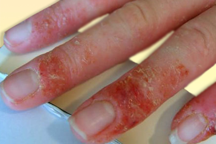 Аллергический контактный фотодерматит Фотодерматит