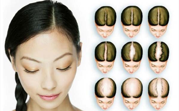 Этапы выпадения волос