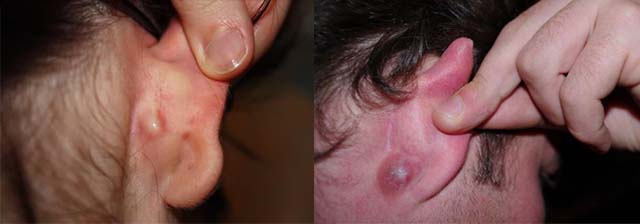 Гнойный лимфаденит за ушами