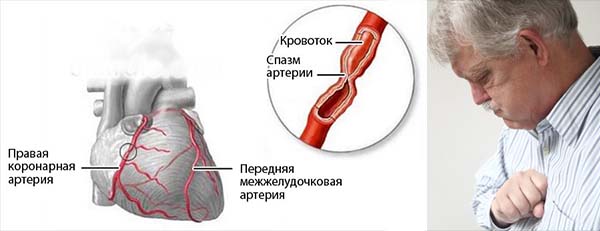 Спазм сердечных сосудов