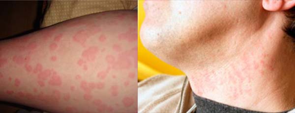 Сыпь и пятна на теле