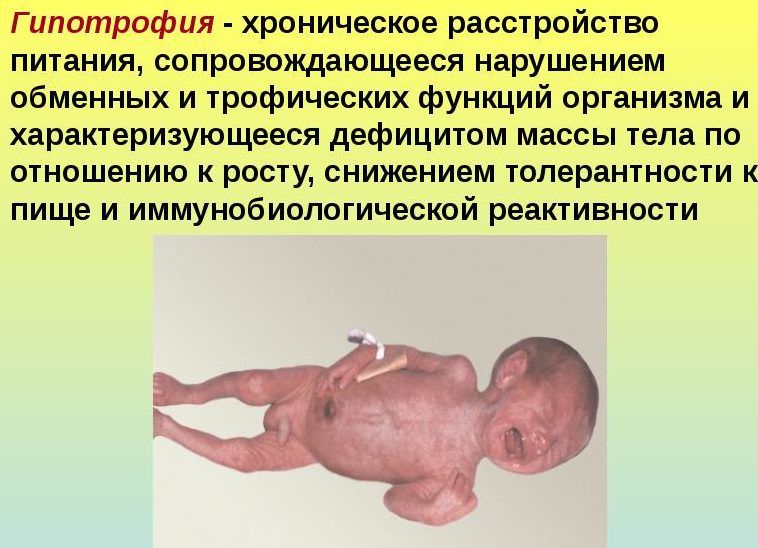 Гипотрофия может вызвать пневмонию