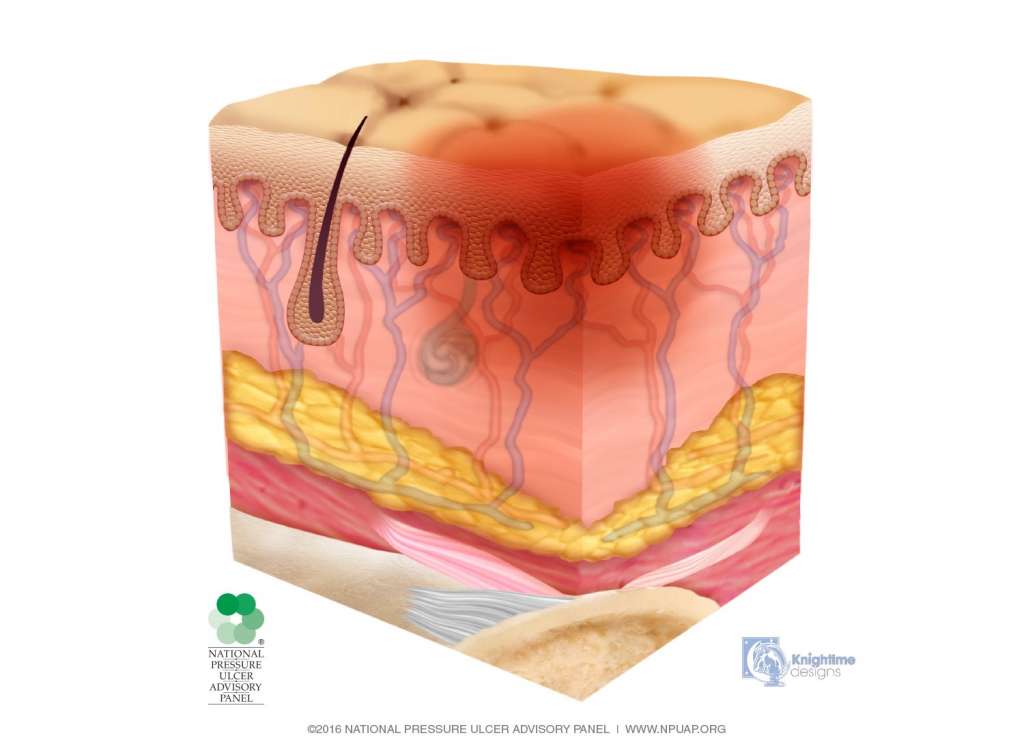 Пролежни 1 стадия (NPIAP) IMG_0006.JPG