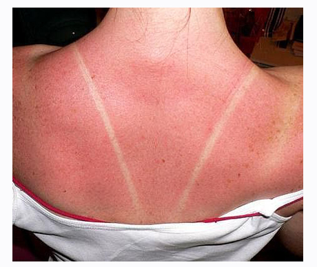 быстро восстановить кожу после солнечного ожога быстро восстановить кожу после солнечного ожога