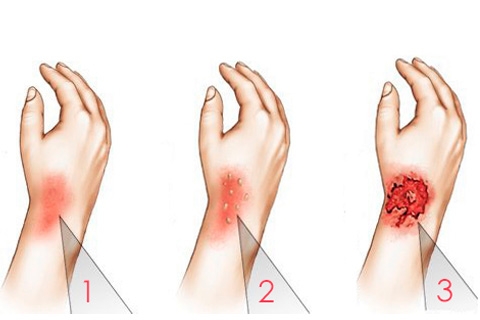 Как выглядят ожоги 3 степени и как их лечить Как выглядят ожоги 3 степени и как их лечить