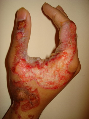 ожоги 3 степени и как их лечить ожоги 3 степени и как их лечить