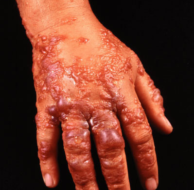 ожоги 3 степени ожоги 3 степени