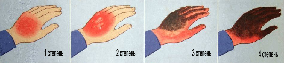 obzhegla-palets-kak-snjat-bol obzhegla-palets-kak-snjat-bol