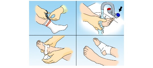 Оказание первой доврачебной помощи при ожогах