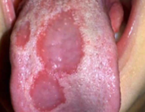 Ожог языка четвертой степени