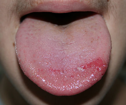 Ожог языка второй степени