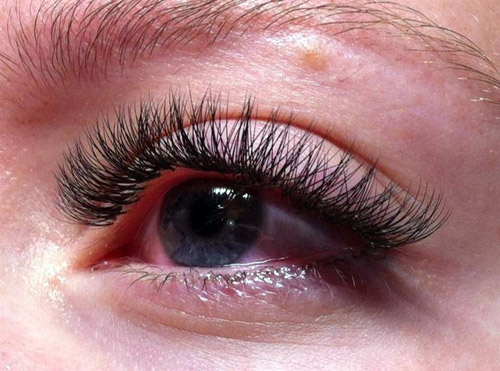 Ожог глазного яблока при наращивании ресниц