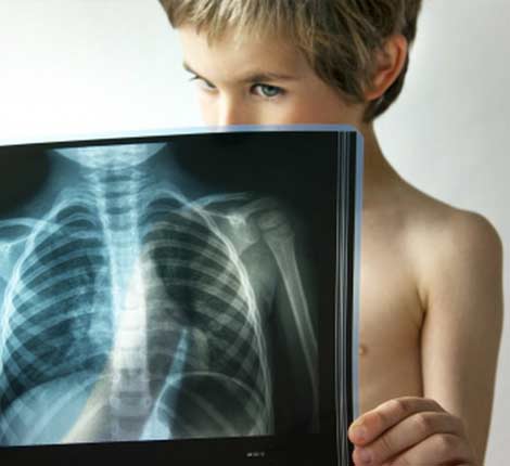 Воспаление легких или пневмония у детей - причины, симптомы, диагностика и лечение В раннем возрасте очень часто пневмония развивается на фоне респираторных вирусных инфекций – ОРВИ, ангины, ринофарингита, бронхита. Вирусы, расселяющиеся в слизистых стенках верхних дыхательных путей, нарушают их защитную функцию, увеличивают образование мокроты и снижают местный иммунитет, что значительно облегчает проникновение патогенной флоры в нижние отделы дыхательной системы.