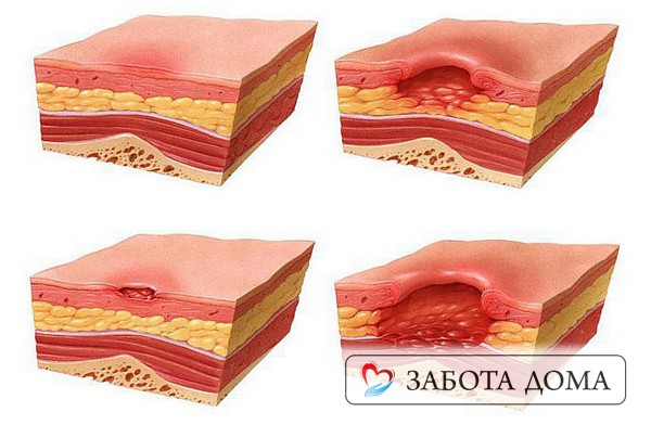 Стадии пролежней Стадии пролежней