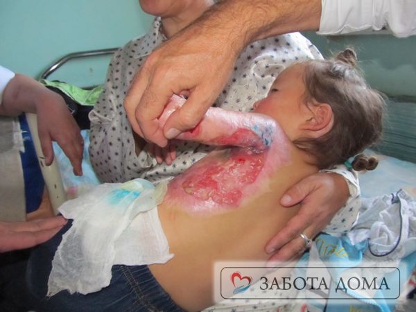 Некротический процесс, который начинается с третьей стадии, способен расплавлять ткани не только в местах повреждения, но и распространяться дальше, затрагивая соседние неповрежденные области, а также кости и хрящи, суставы и органы Обширный пролежень у ребенка